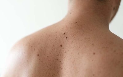 Så skyddar du dig bäst mot hudcancer